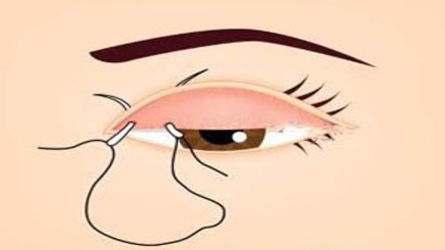 割双眼皮手术到底要多少钱？